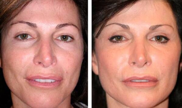 fotos antes después del rejuvenecimiento de la piel facial con plasma