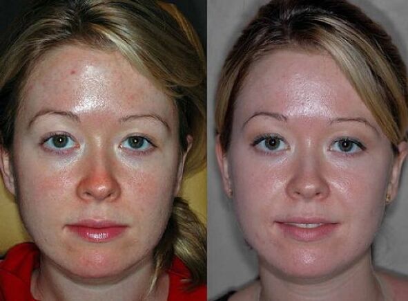 imágenes antes y después del procedimiento de rejuvenecimiento con plasma