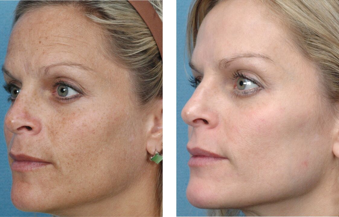 fotos de rejuvenecimiento de la piel antes y después 1