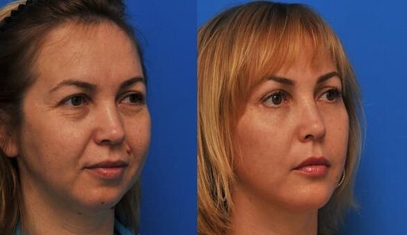 antes y después del rejuvenecimiento de la piel apretando la foto 1