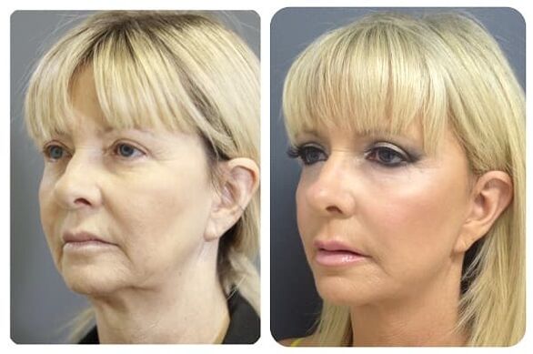 antes y después del rejuvenecimiento de la piel apretando la foto 2