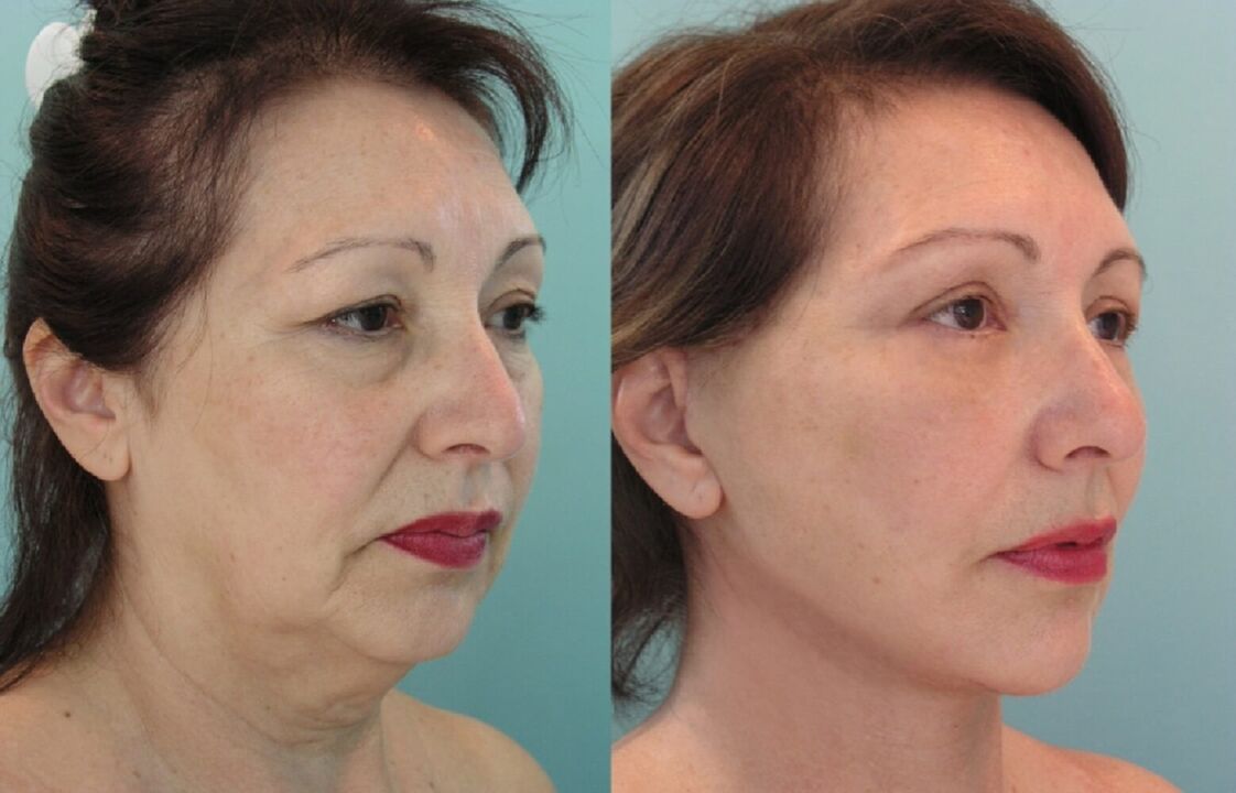 Hilo antes y después del lifting facial