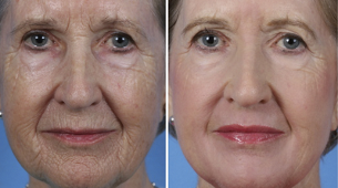 rejuvenecimiento facial fraccionado fotos antes y después