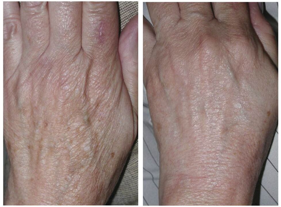 fotos de antes y después de rejuvenecimiento de manos con láser